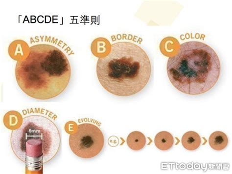 痣 顏色|痣有4種顏色，出現在「手腳這邊」的痣可能是皮膚癌！「ABCDE。